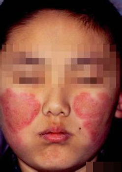儿童系统性红斑狼疮症状是什么